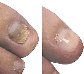 nail repair
